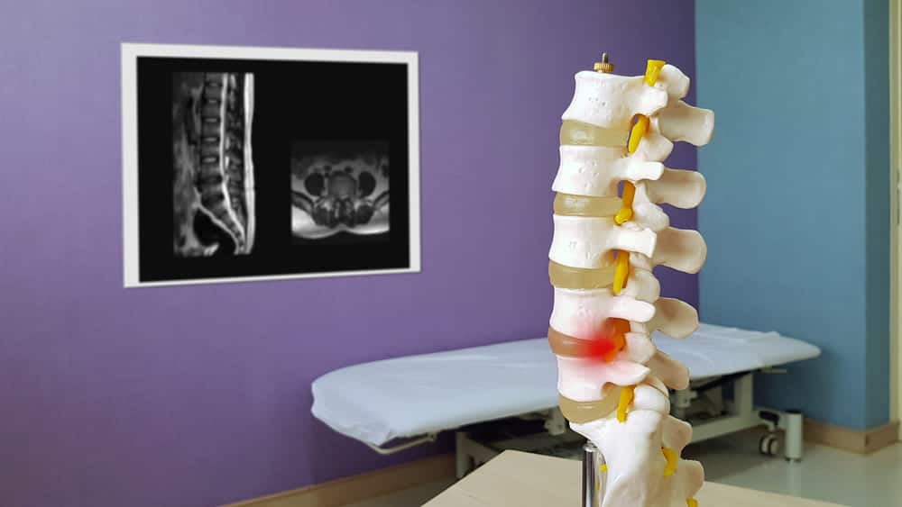 Lumbar Stenosis