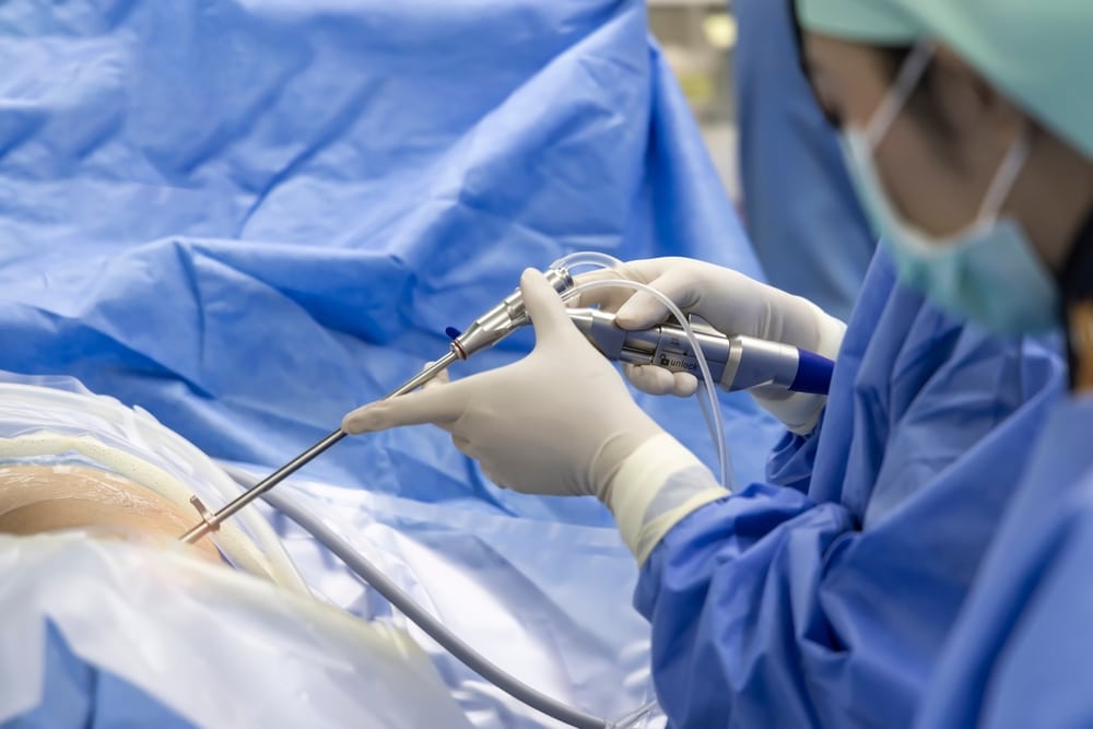 Minimally Invasive Spine Surgery for Sciatica: What To Expect