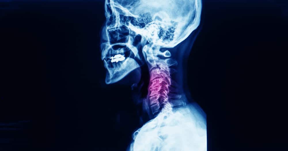 Cervical disc replacement