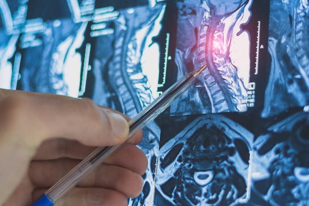 Thoracic Spine Pain
